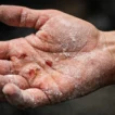Worn hands and calluses caused by HYROX training and racing