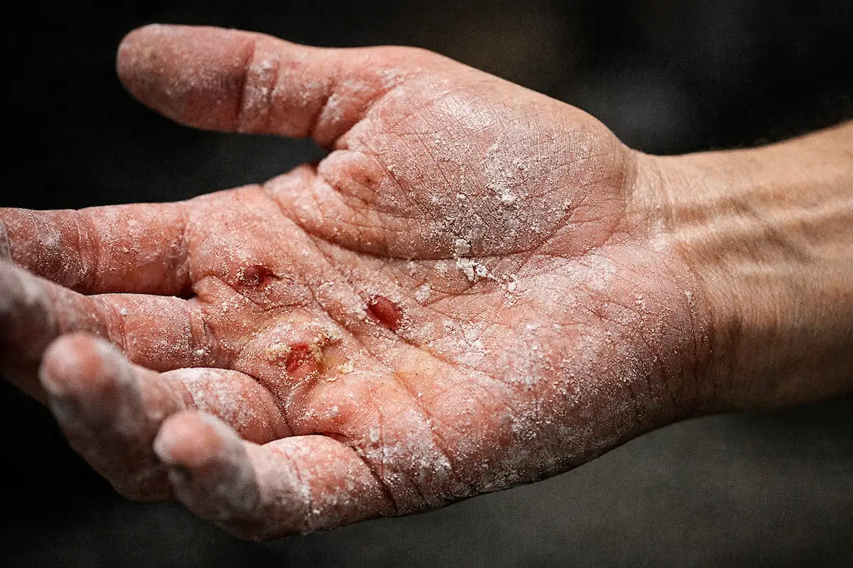 Worn hands and calluses caused by HYROX training and racing